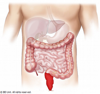 Featured image of post Ulcerative Colitis Flare Up Symptoms : Ulcerative colitis is a chronic bowel disease with symptoms that flare up and die down.